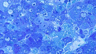 This photomicrograph shows hepatitis caused by the Lassa virus, using toluidine-blue azure II stain, 1972. The Lassa virus, which can cause altered liver morphology with hemorrhagic necrosis and inflammation, is a member of the family Arenaviridae, and is a single-stranded RNA, zoonotic, or animal-borne pathogen. Image courtesy CDC/Dr. W. Winn. (Photo by Smith Collection/Gado/Getty Images).