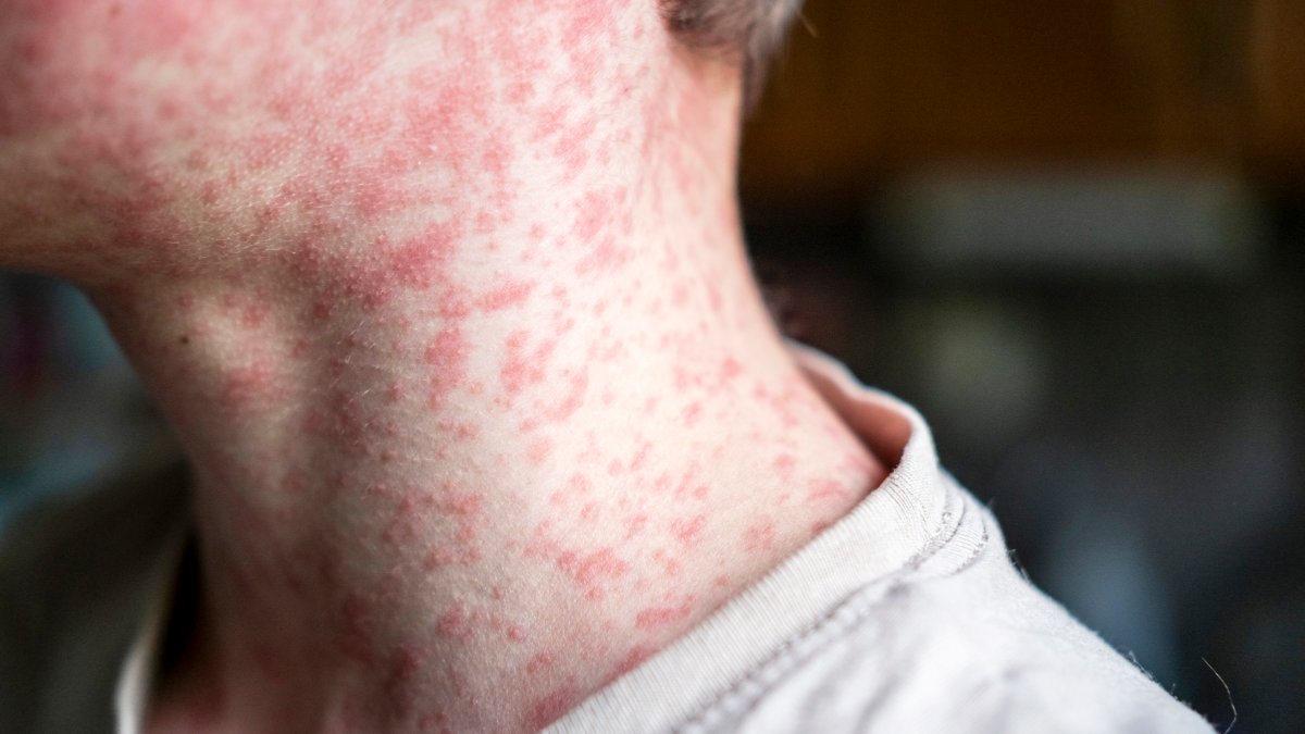 IDPH holds update on measles in Illinois as cases across U.S. keep rising