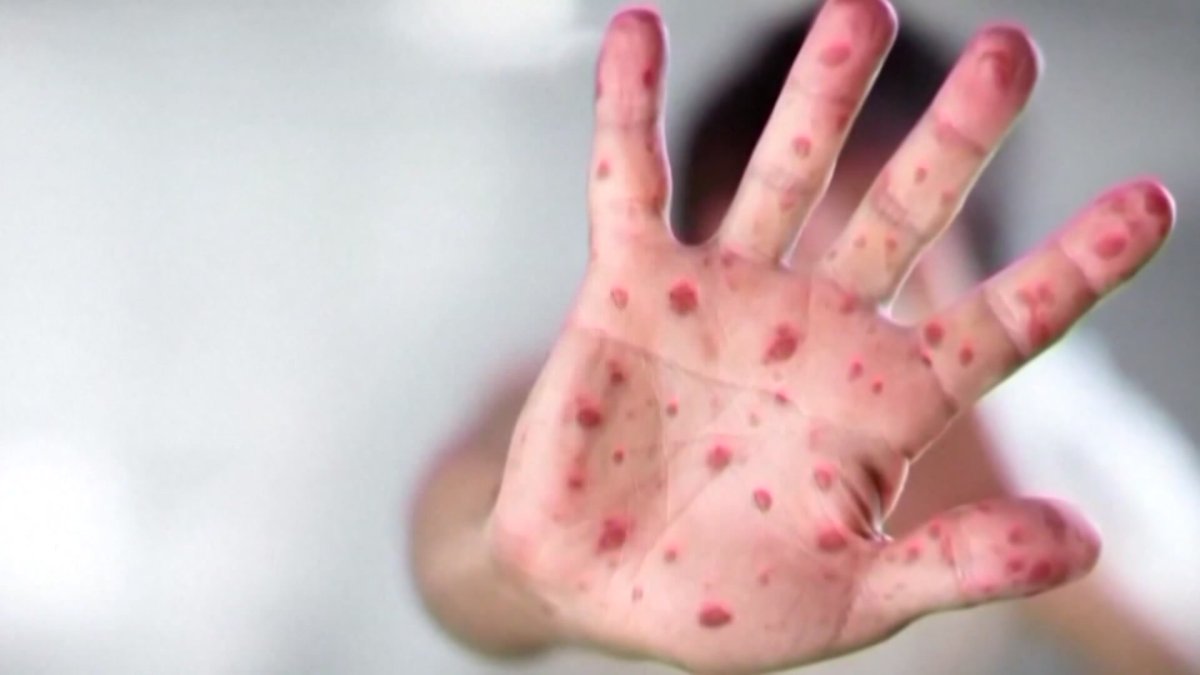 Cook County confirms new measles case in 4-year-old suburban Chicago child