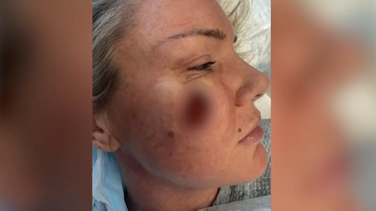 Routine skin check turns to nightmare as woman leaves with gaping hole in her face
