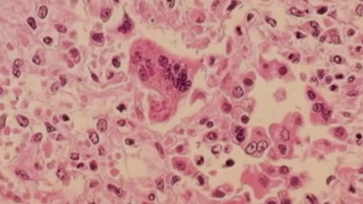 Health officials warn of possible measles exposure at O'Hare Airport, suburban stores