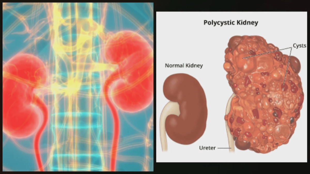 New bill in Congress would aim for cure to common kidney disease New bill in Congress would aim for cure to common kidney disease