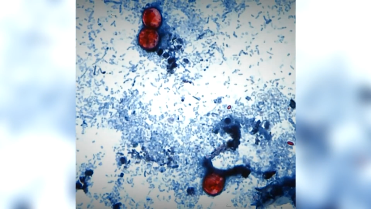 ‘Considerably higher: Cyclosporiasis cases rise again. Latest update for Illinois ‘Considerably higher: Cyclosporiasis cases rise again. Latest update for Illinois