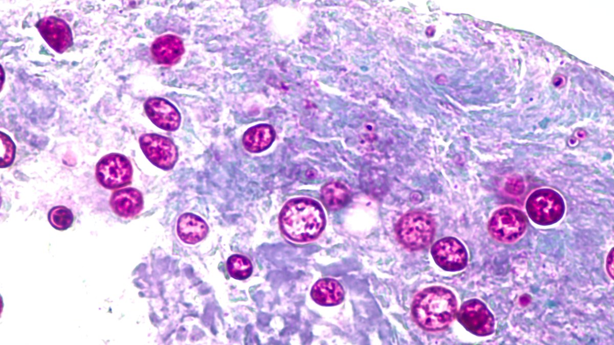 Cases of ‘explosive diarrhea' infections spread in U.S., with major Midwest outbreak