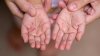 Hand, foot and mouth disease cases reported at Kane County high school