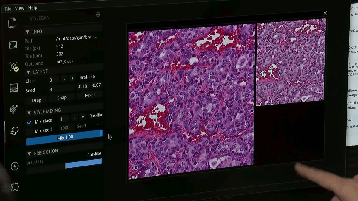 How a UChicago clinical trial using AI aims to personalize breast cancer treatment How a UChicago clinical trial using AI aims to personalize breast cancer treatment