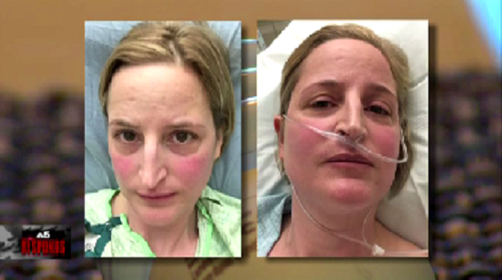 Discoid Lupus And Fluorescent Lighting Shelly Lighting